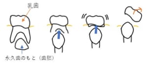 西宮北口　歯医者　乳歯がゆれる