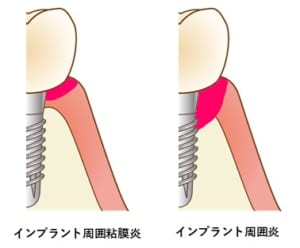 西宮北口　歯医者　インプラント周囲炎